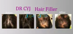 هیرفیلر ( هیر فیلر ) dr cyj hair filler