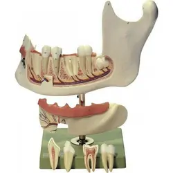 مولاژ آرواره پایین تا 18 سال