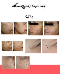دستگاه پلاژن سه بازو هندپیس سه کاره جوانسازی و زیبا سازی پوست pollogen OxyGeneo