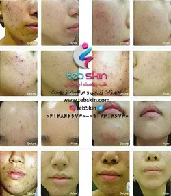 تونل نوردرمانی 7 رنگ LED کلسیم تراپی Devoir Plm002