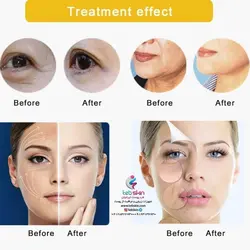 دستگاه هایفو HIFU سالنی صورت و بدن کمپانی BYL