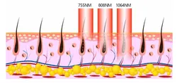 دستگاه لیزر الکس دایود ADSS