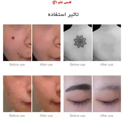 دستگاه نیت سل پاک کننده تتو و خال Neatcell - فروشگاه اینترنتی قاسمی شاپ