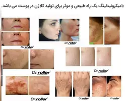 درمارولر زد جی تی اس ZTGS مدل کلینیکیرز clinicares