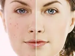 ست پنج عددی مراقبتی و آرایشی هیدراته، هیالورونیک اسید ونزنSet of Skin VENZEN