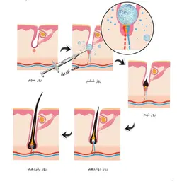 فیلر رشد و تقویت مو هیرفیلر برند DR.CYJ