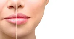 فیلر ژل سوفیدرم درم پلاس 10ml هیالورونیک اسید Sofiderm Derm Plus