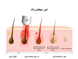 قیمت و مشخصات دستگاه لیزر الکساندرایت ۲۰۲۴ -رونیکاشاپ