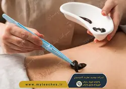 خرید انلاین پک 20 عددی زالو طبی