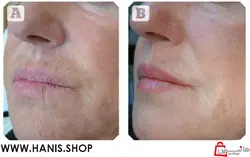 مزوژل پروفایلو 2 سی سی ایتالیا Profhilo