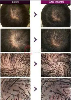 هیر فیلر مو کره ای Hair Filler Dr.Cyj