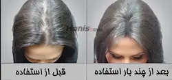کوکتل میکرونیدلینگ تقویت و رشد موی توسکانی Toskani Hcpr