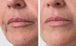 فیلر الیاکسین sr | فروشگاه اینترنتی حیان طب