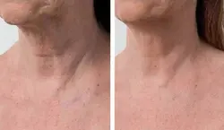 فیلر الیاکسین sr | فروشگاه اینترنتی حیان طب