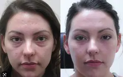 فیلر زیر چشم ژوویدرم | فروشگاه اینترنتی حیان طب