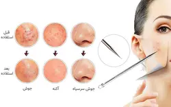 میله پیلینگ پاکسازی صورت