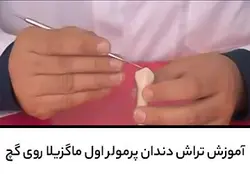 آموزش تراش دندان پرمولر اول ماگزیلا روی گچ