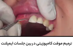 ترمیم موقت کامپوزیتی در بین جلسات ایمپلنت