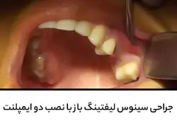 جراحی سینوس لیفتینگ باز با نصب دو ایمپلنت
