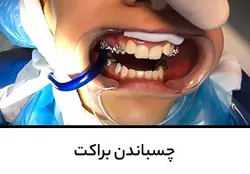 چسباندن براکت