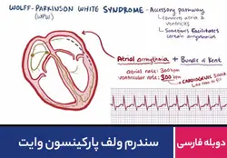 سندرم ولف پارکینسون وایت