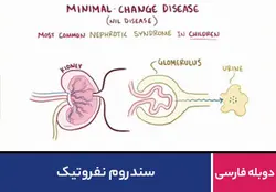 سندروم نفروتیک