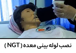 نصب لوله معده ( NGT )