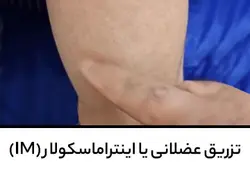آموزش تزریق عضلانی یا اینتراماسکولار (IM)