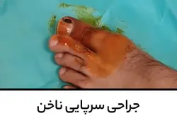 آموزش جراحی سرپایی ناخن