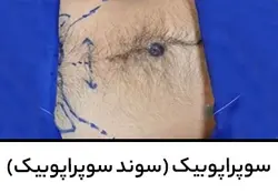 سوپراپوبیک (سوند سوپراپوبیک)