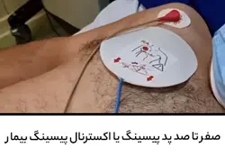 آموزش صفر تا صد پد پیسینگ یا اکسترنال پیسینگ بیمار