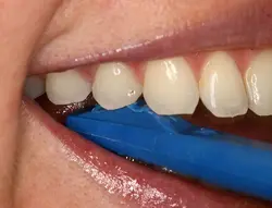 ابزار تشخیص پوسیدگی