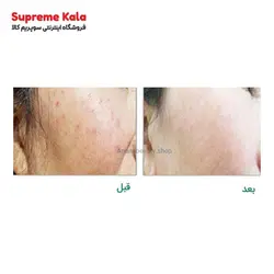سرم آربوتین لیزر وایت - سوپریم کالا