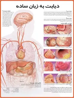 پوستر دیابت به زبان ساده