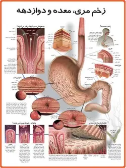 پوستر زخم مری، معده و دوازدهه
