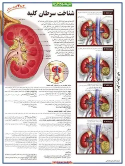 پوستر شناخت سرطان کلیه
