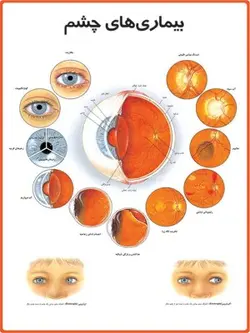 پوستر بیماری‌های چشم