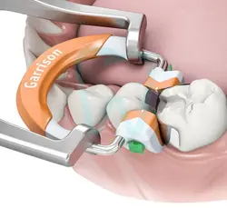 Fussion Tight Molar - رینگ سکشنال گریسون