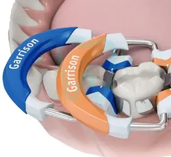 Fussion Tight Premolar - رینگ سکشنال گریسون