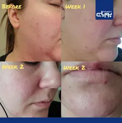 سرم لاکتیک اسید ۱۰ درصد اوردینری ۳۰ میل _  Ordinary Lactic Acid