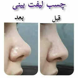 چسب لیفت بینی