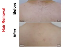 لیزر  Duetto MT EVO - فروشگاه آنلاین مطب چین