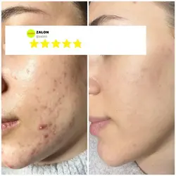 ماسک درمانی زردچوبه زالون zalon - زیبارو فروش عمده لوازم آرایشی و بهداشتی