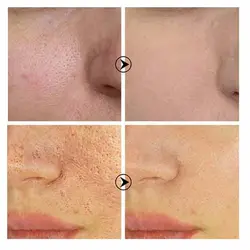سرم کوچک کننده منافذ پوست بریلی Breylee Pore Minimizer Serum Step 2