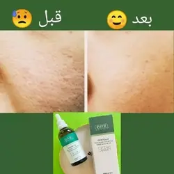 سرم بستن منافذ تخصصی گیاه سنتلا BAIZTON