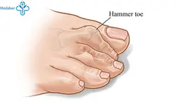 لاانگشتی هَمِر تو طب و صنعت 10800