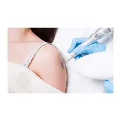 لیزر حرفه ای کیوسوییچ حذف خال زگیل و تاتو (تتو) 3000 میلی ژول طرح جدید مدل 2020