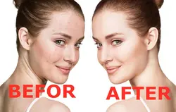 ماسک هیدروژلی درخت چای