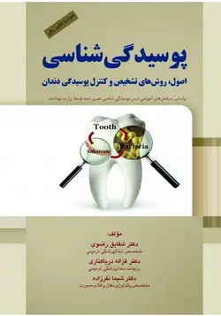 پوسیدگی شناسی اصول روش های تشخیص و کنترل پوسیدگی دندان [ رویان پژوه ]