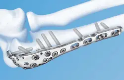 پلاک آناتومیکال اولکرانون با لاک - طب دائم - TebDaem